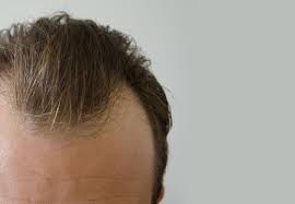 头发移植的效果能持续多久