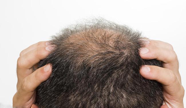 如何治疗脂溢性脱发最有效