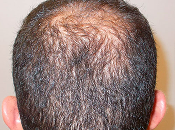 怎样治疗脂溢性脱发？脂溢性脱发的原因有哪些？