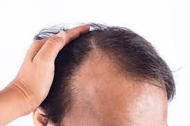 脂溢性脱发的临床表现