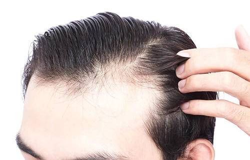 毛发种植手术后应该怎么护理?