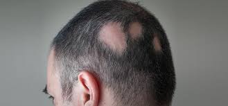疤痕种植头发需要具备什么条件