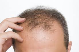 治疗脂溢性脱发的偏方