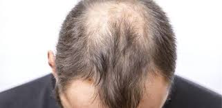 脂溢性脱发可以自愈吗?中药可以治疗脂溢性脱发吗?
