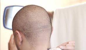 头上有伤疤能种植头发吗?怎样处理头部疤痕呢?