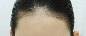 发际线头发稀疏怎么治疗