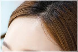 发际线头发稀疏怎么治疗?种发际线有没有什么影响?