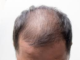 男性脱发原因有哪些？如何治疗男性脱发？