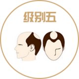 前额和额角的头发后退明显。头顶部位和前发际线间毛发带更狭小和精疏。